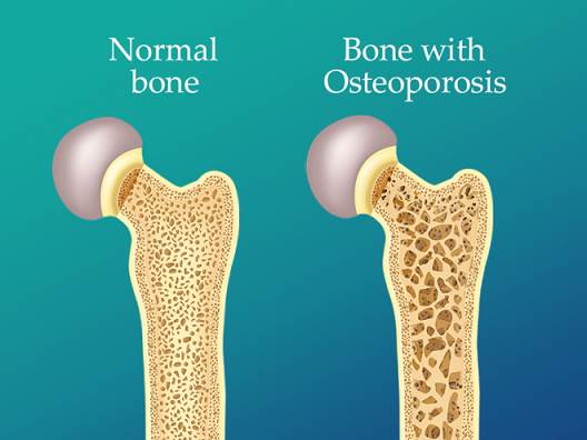 Cuidado con la Osteoporosis