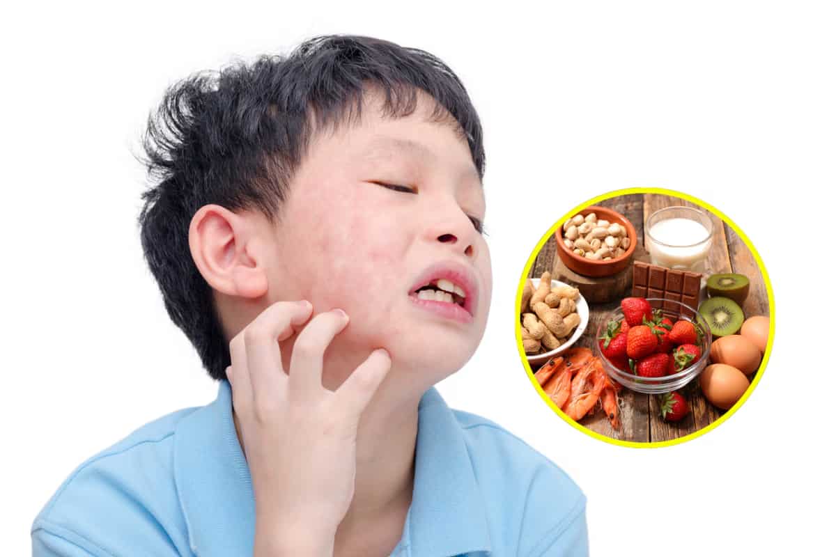 Alergias alimentarias en niños: síntomas, diagnóstico y alimentos más problemáticos