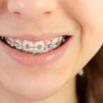 Brackets para niños: tipos, precios y duración del tratamiento