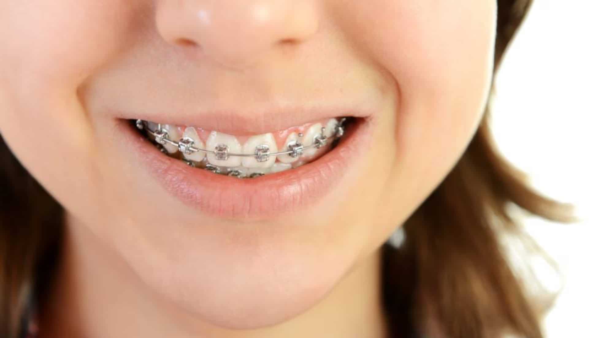 Brackets para niños: tipos, precios y duración del tratamiento